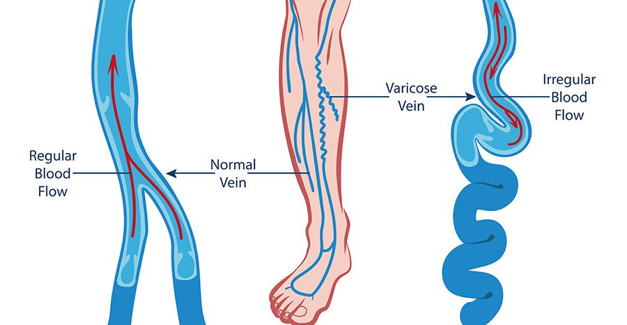varicose vein